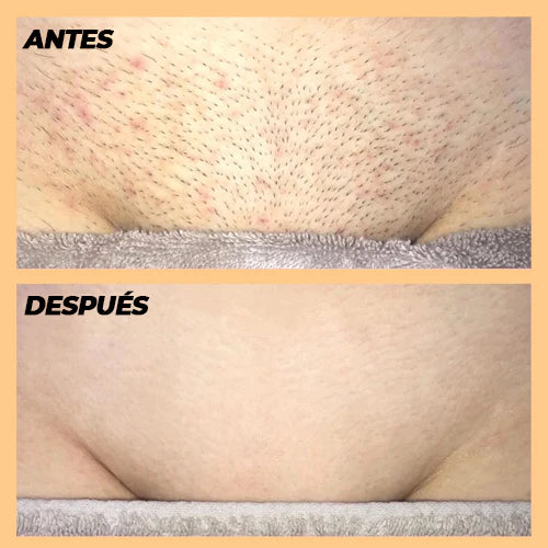 Láser Derm Pro - Depilación Avanzada para una Piel Impecable